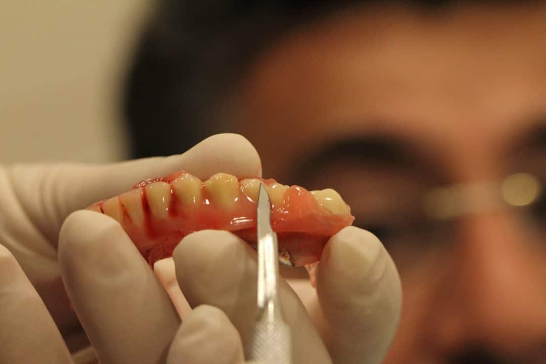 SOFRELINER TOUGH® - Chairside Soft Denture Reline Material