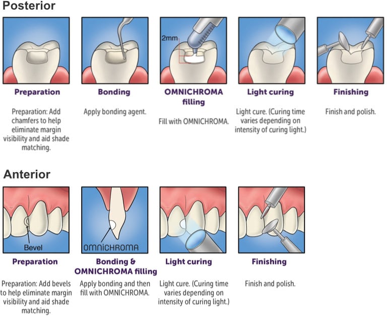 Procedure Guide Posterior Top